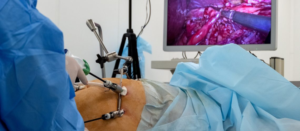 A team of surgeons using endo-instruments operate the patient's abdomen. Endoscopy. Surgery on the body of a complete woman is broadcast online on a monitor or high-definition television. Operating room in the hospital. Surgical table. Endovideosurgery.