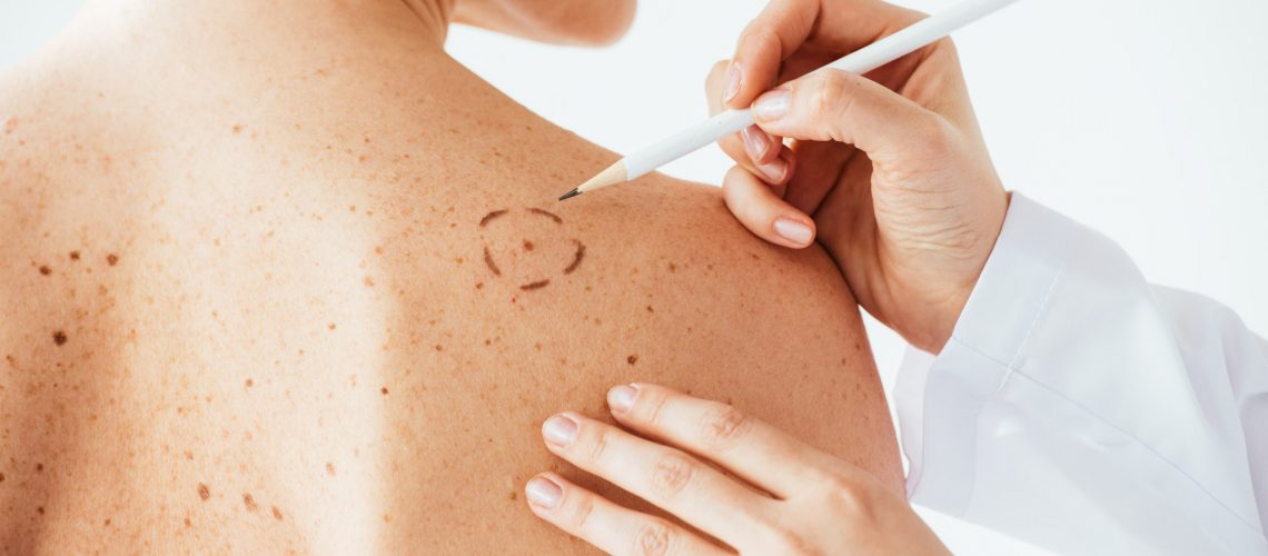 cropped view of dermatologist applying marks on skin of naked woman with melanoma isolated on white